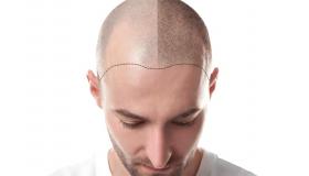 أهم الأسباب التي جعلت تركيا الوجهة الأولى لعمليات زراعة الشعر